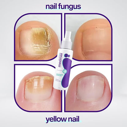 Jaysuin - Nail Fungus Spray